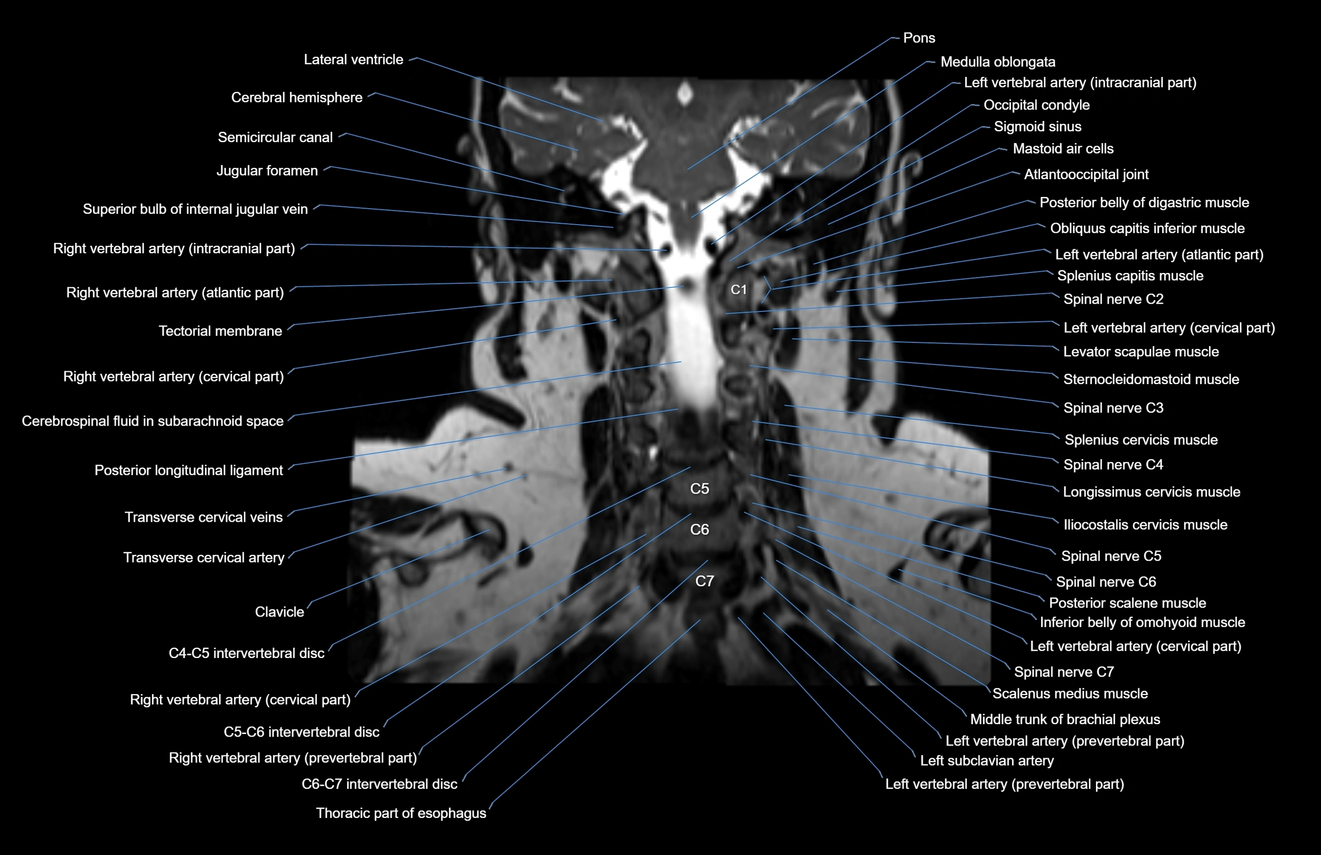 Neck coronal cross sectional MRI anatomy 3T MRI  image-img-00001-00027.webp
